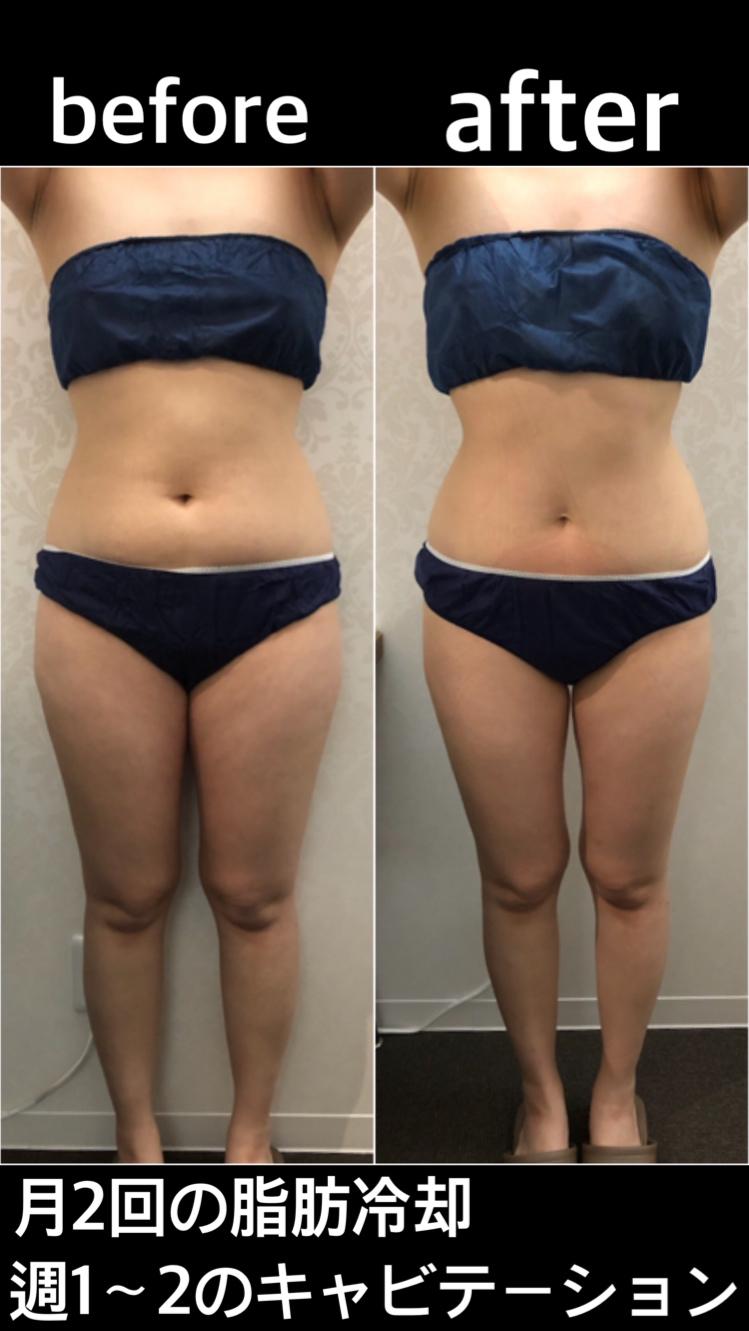 脂肪冷却③ 脂肪冷却③